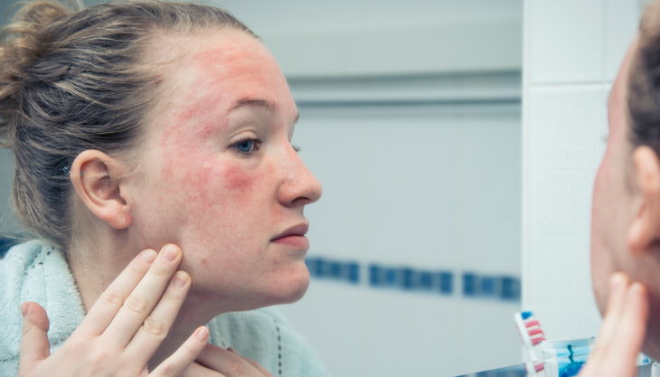 Как выглядит аллергия на косметику на лице фото