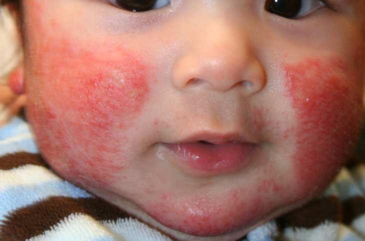 Кольцевидный дерматит у ребенка фото thumbnail