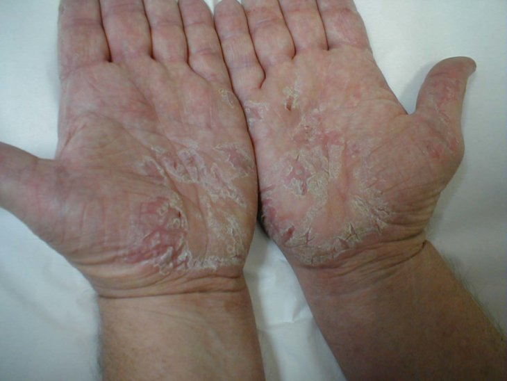 Аллергия на коже дерматит фото thumbnail