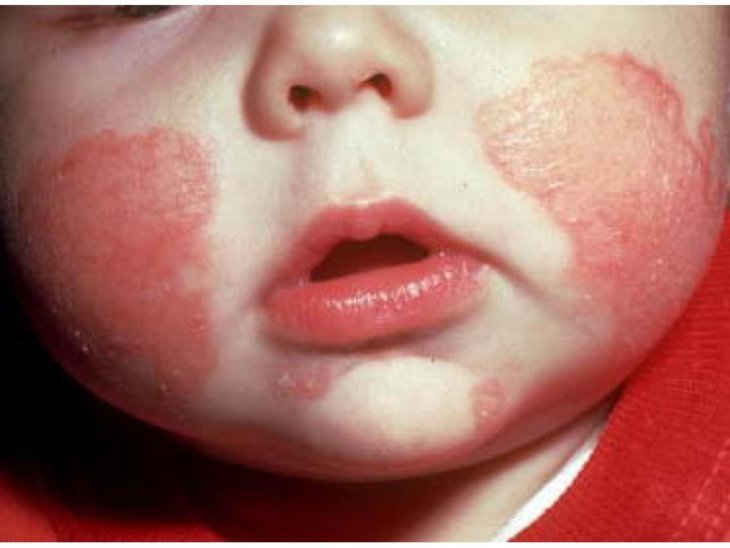 Кожный дерматит у детей картинки