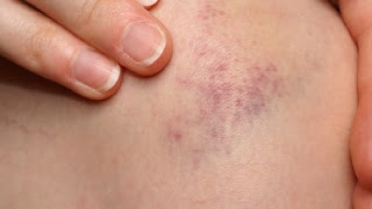 Как выглядит аллергический дерматит картинки thumbnail