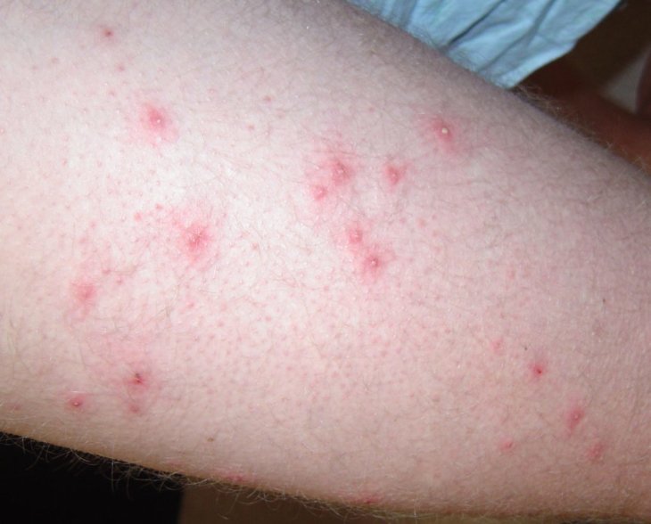Острые и хронические дерматиты фото thumbnail