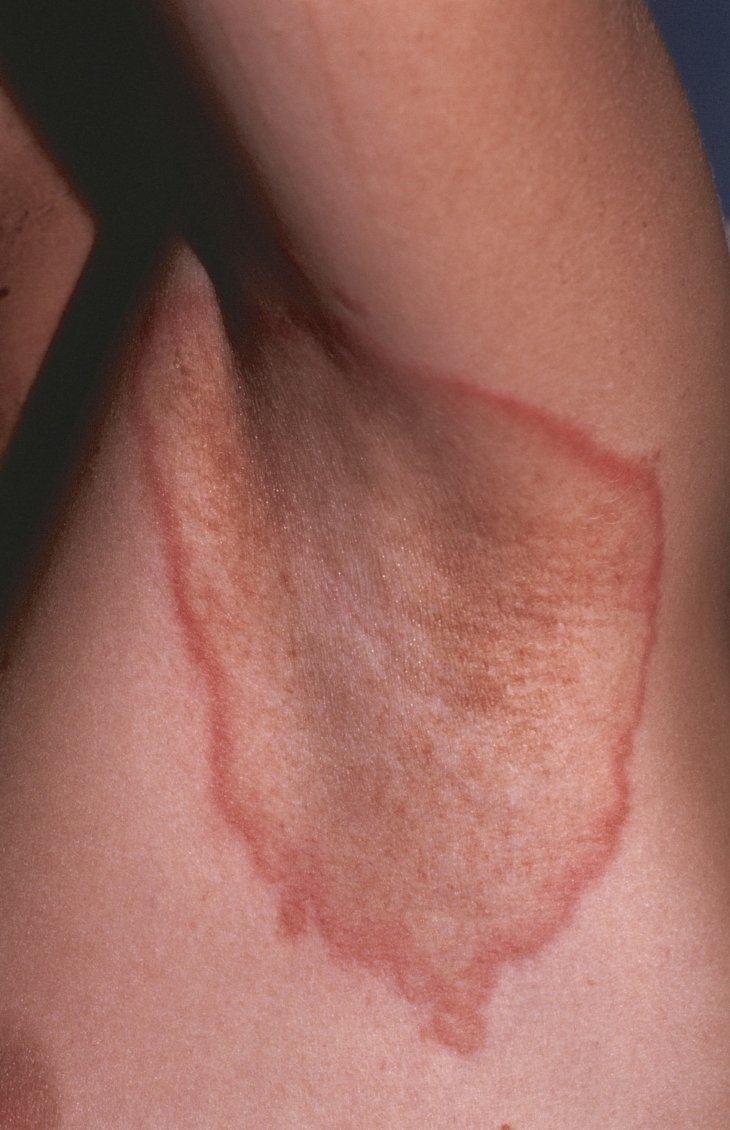 Аллергический дерматит на теле у взрослого фото thumbnail