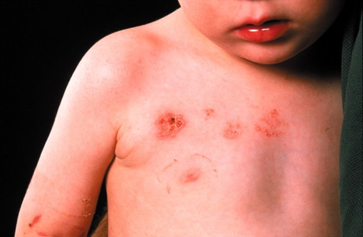 Как выглядит дерматит по всему телу