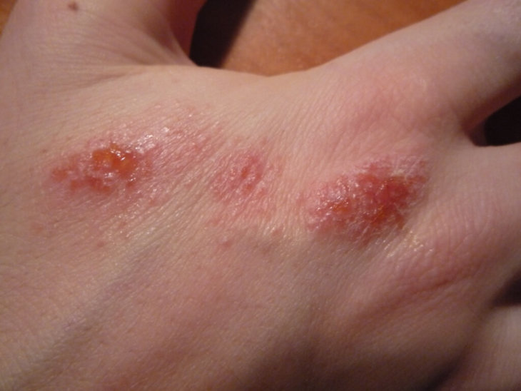 Как выглядит аллергический дерматит картинки