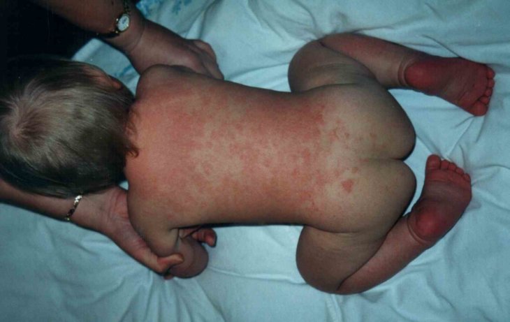 Аллергический дерматит как он выглядеть