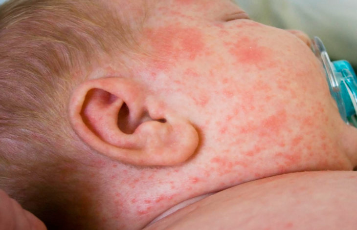Как выглядит дерматит на кожи взрослого
