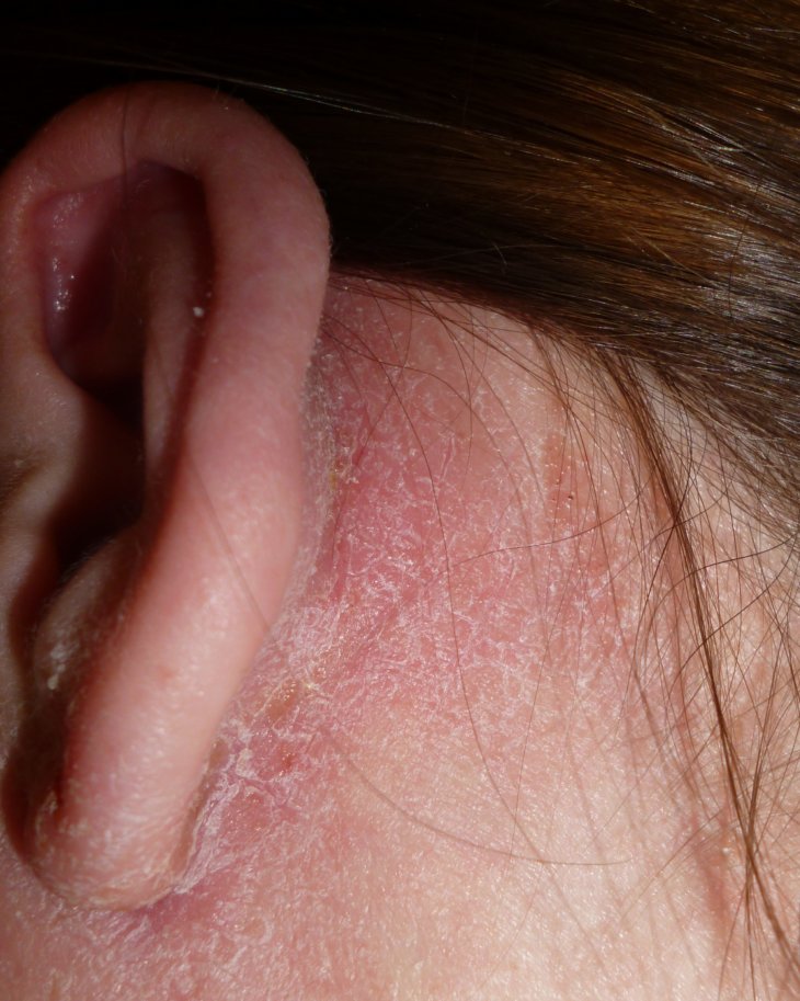 Как выглядит кожное заболевание дерматит