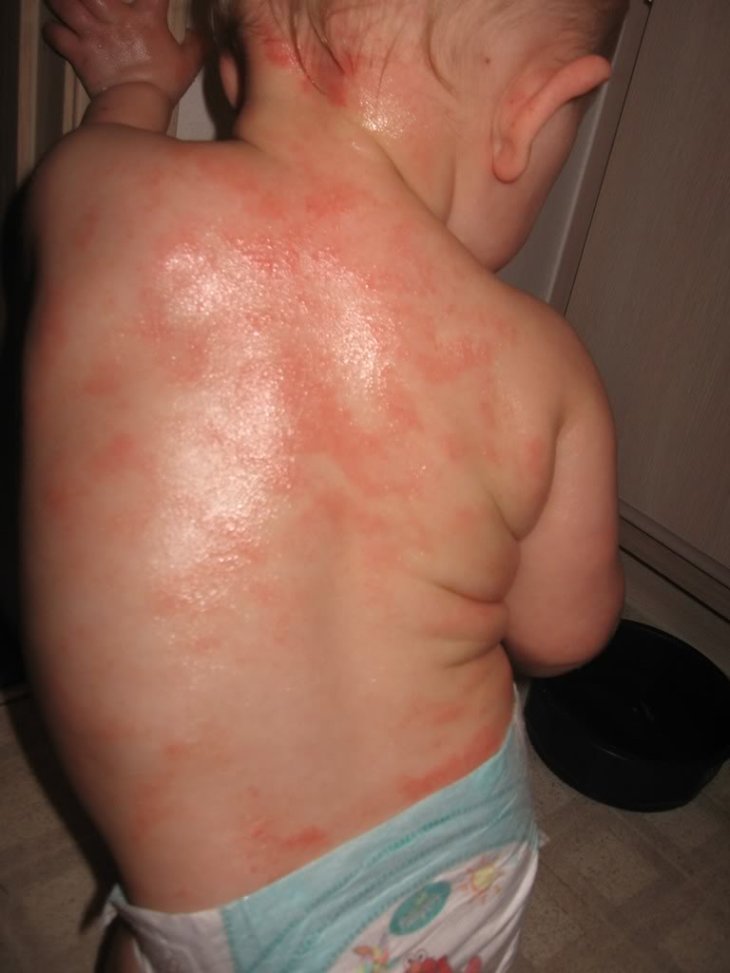 Как выглядит аллергический дерматит картинки