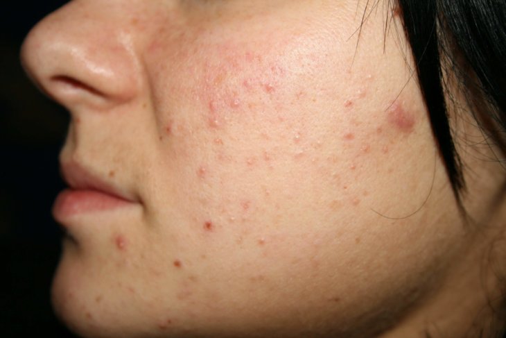 Что такое кожное заболевание дерматит фото thumbnail