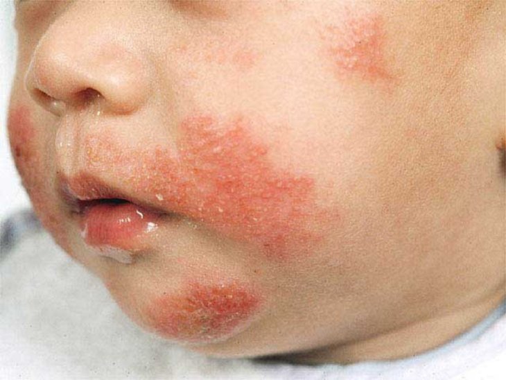 Пищевая аллергия у детей фотографии