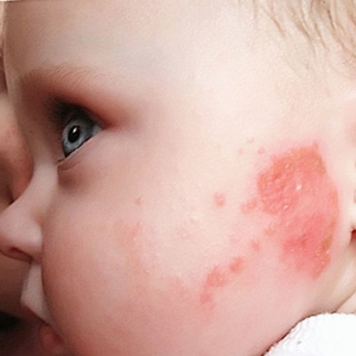 Пищевая аллергия у детей фотографии
