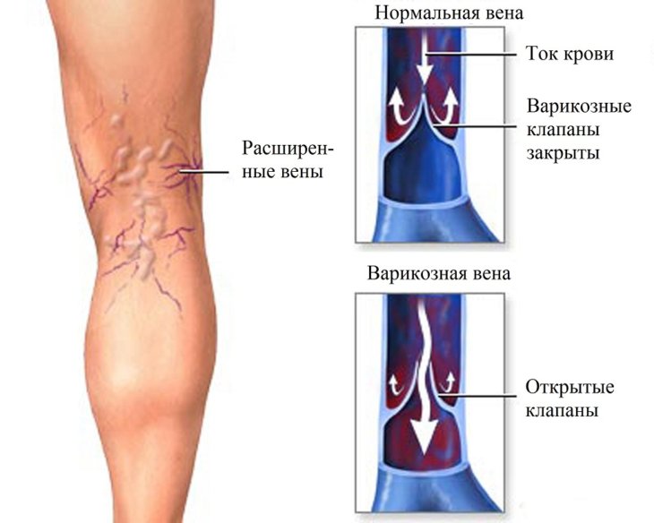 Что такое варикозное расширение вен на ногах симптомы и лечение фото