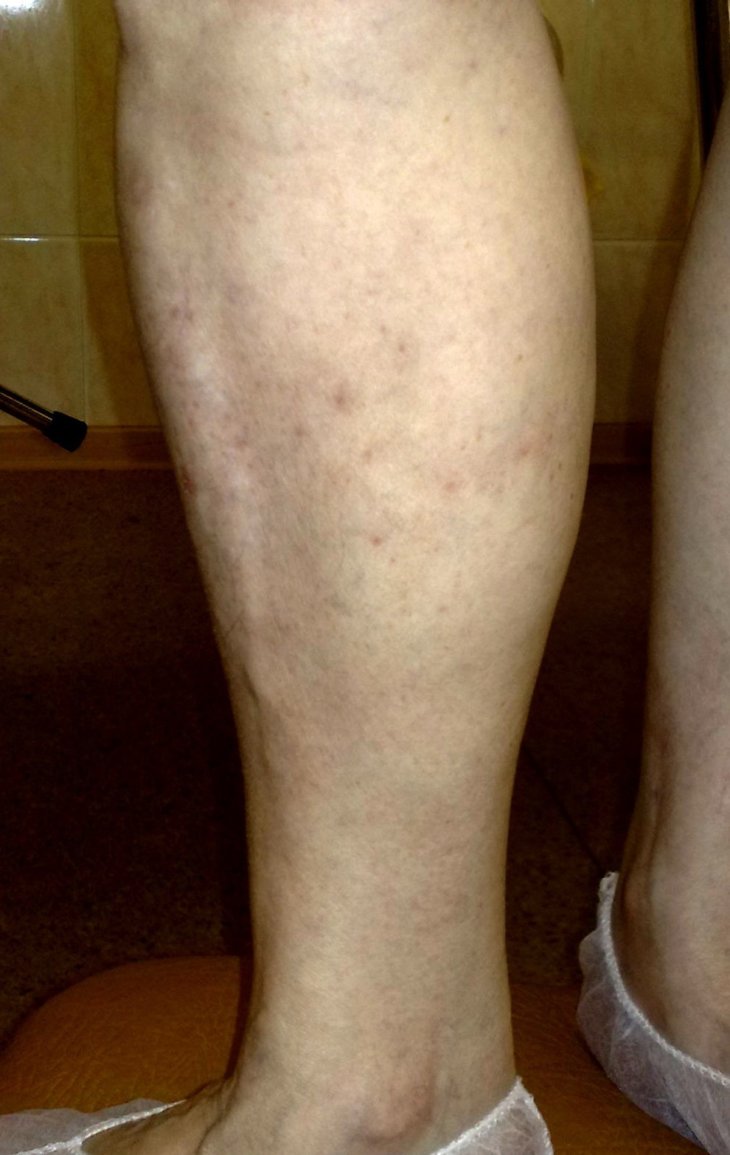Варикоз на ногах у женщин лечение фото