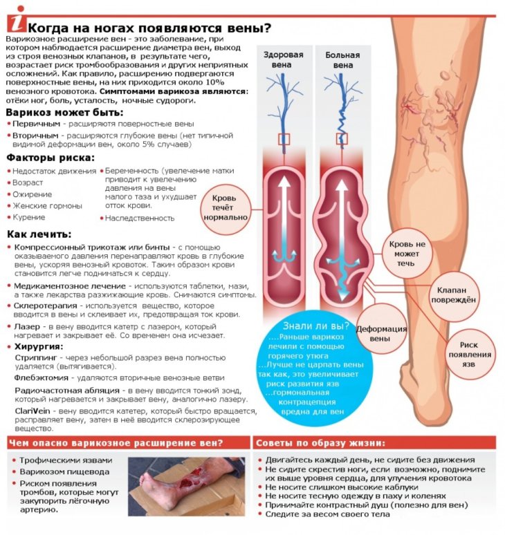 Варикозное расширение вен на ногах фото симптомы и лечение в домашних