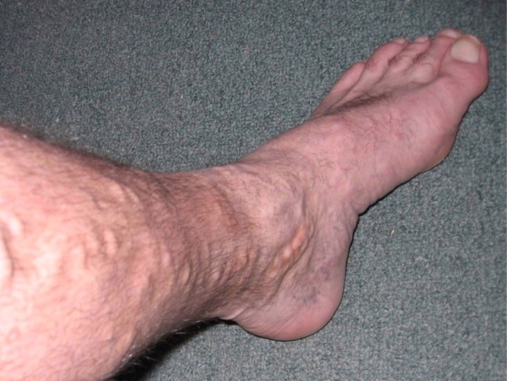 Фото варикозное расширение вен на ногах лечение в домашних условиях фото