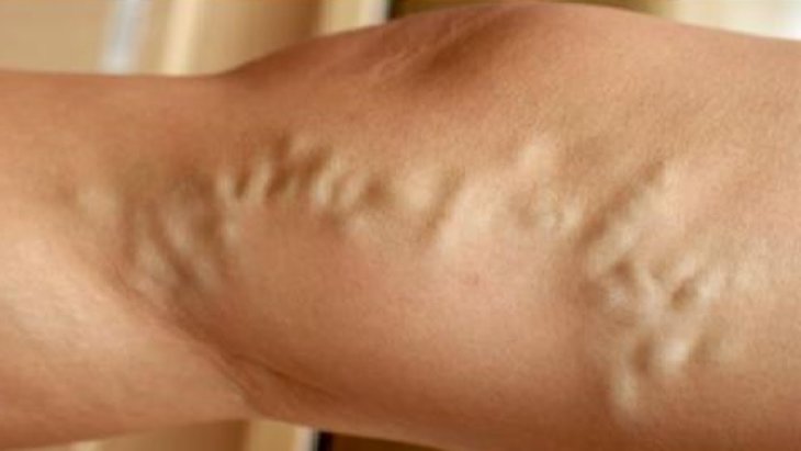 Вены на ногах симптомы и лечение фото