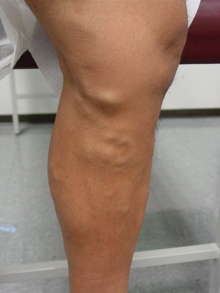 Варикозное расширение вен на ногах лечение фото стадии