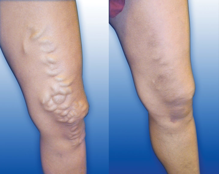 Варикозное расширение вен на ногах лечение фото стадии