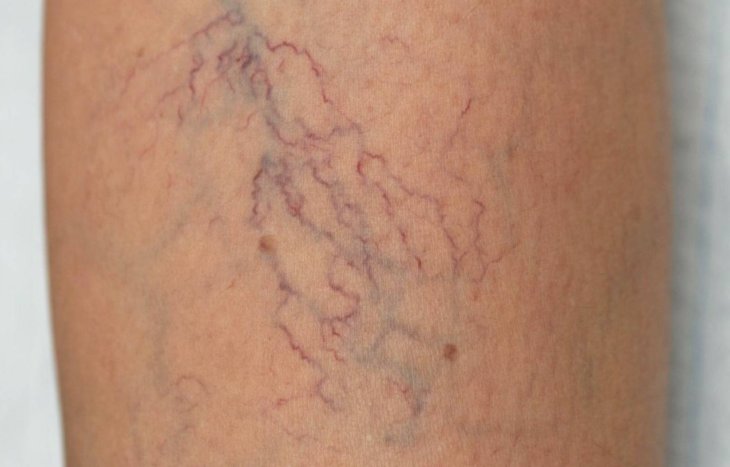 Что такое варикозное расширение вен на ногах симптомы и лечение фото