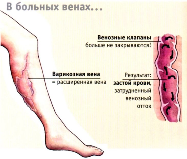 Варикозная болезнь ног фото thumbnail