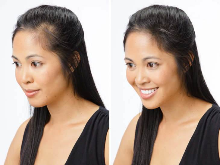 Как лечить волос выпадение фото