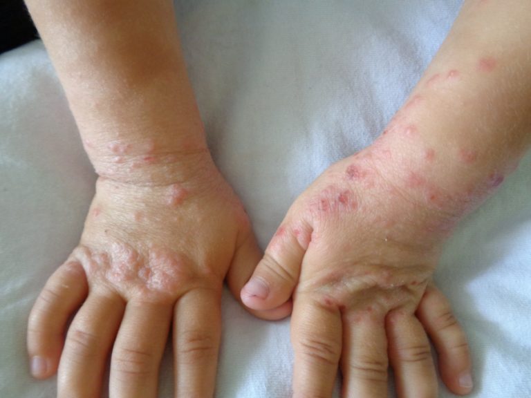 Что такое дерматит и как оно выглядит