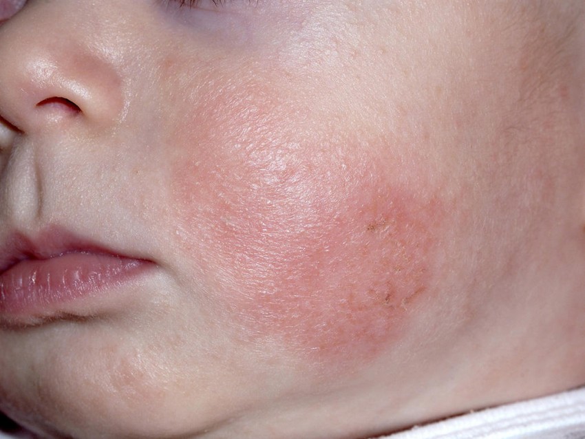 Виды аллергический дерматит фото у взрослых thumbnail