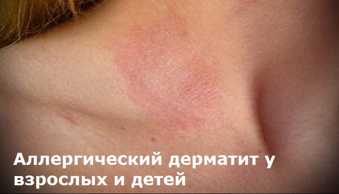Виды аллергического дерматита в картинках thumbnail
