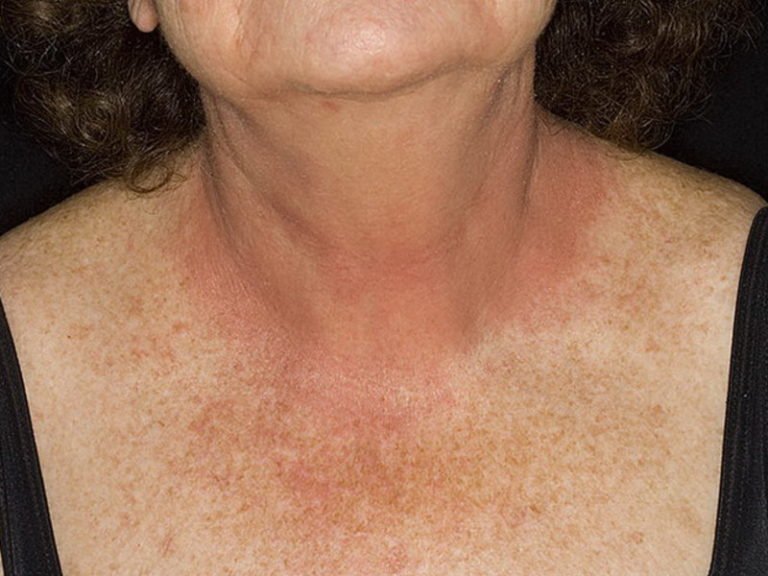 Пустулезный дерматит у человека фото thumbnail
