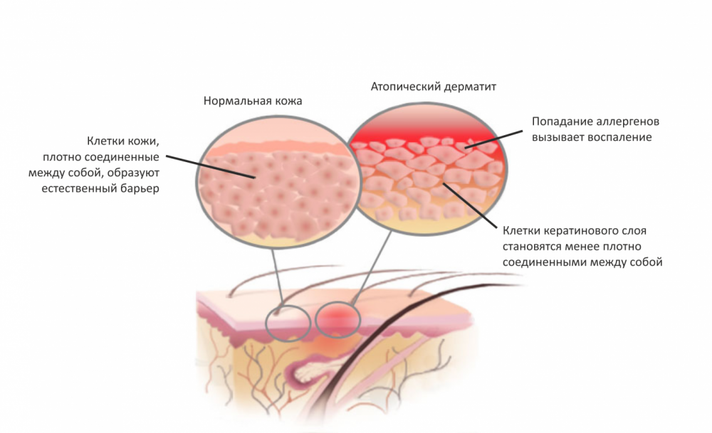 Розовый дерматит у человека thumbnail