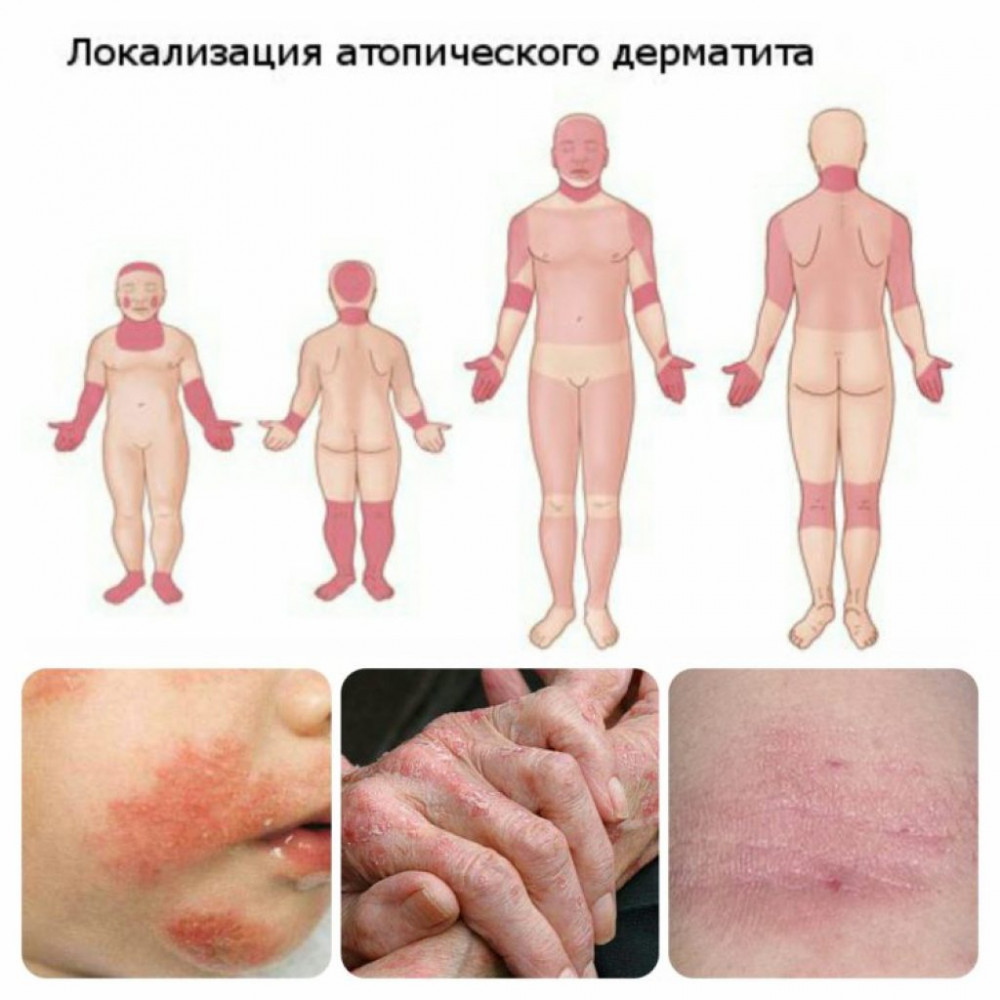 Как выглядит дерматит на кожи взрослого