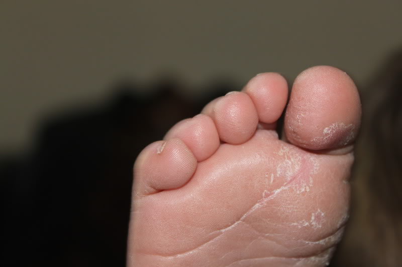 Белая кожа вокруг пальцев ног
