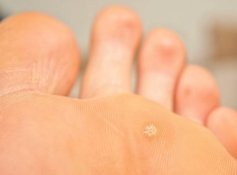 Грибок кожи большого пальца на ноге лечение