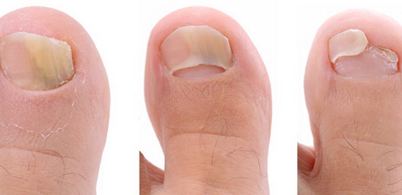 Признаки грибка на пальцах ног и лечение